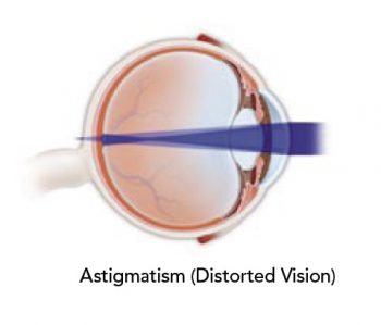 correction-astigmatism