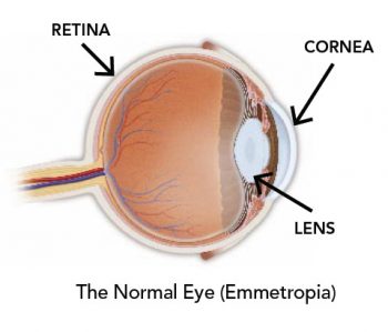 correction-emmetropia