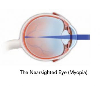 correction-myopia